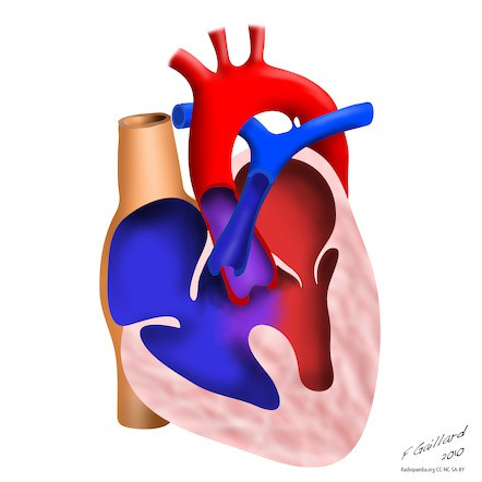 Tetralogy of Fallot